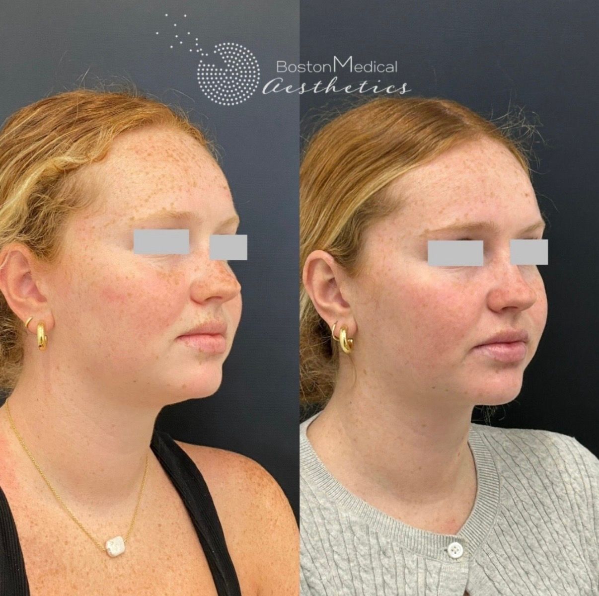 Kybella Before & After Photo