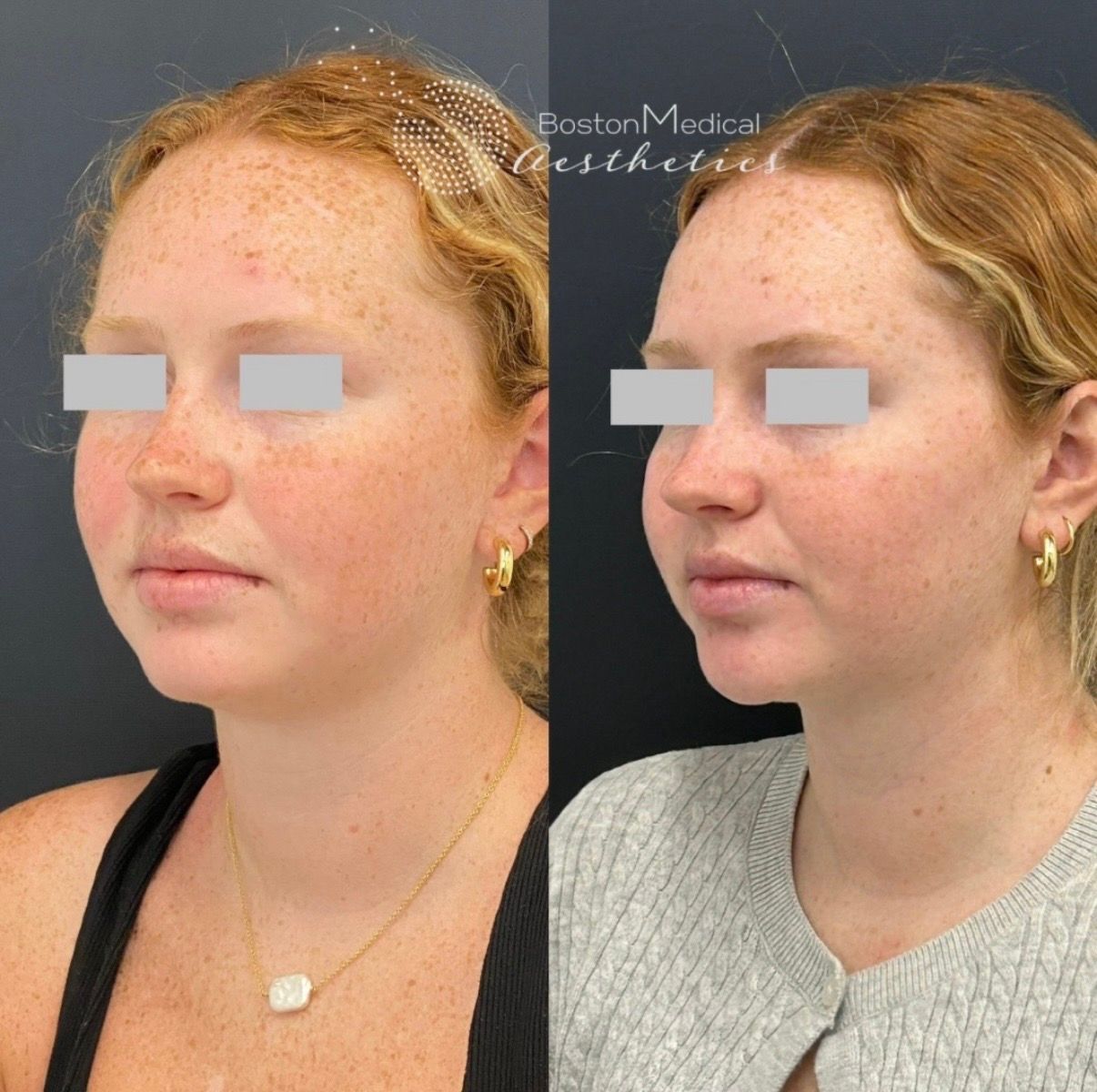 Kybella Before & After Photo