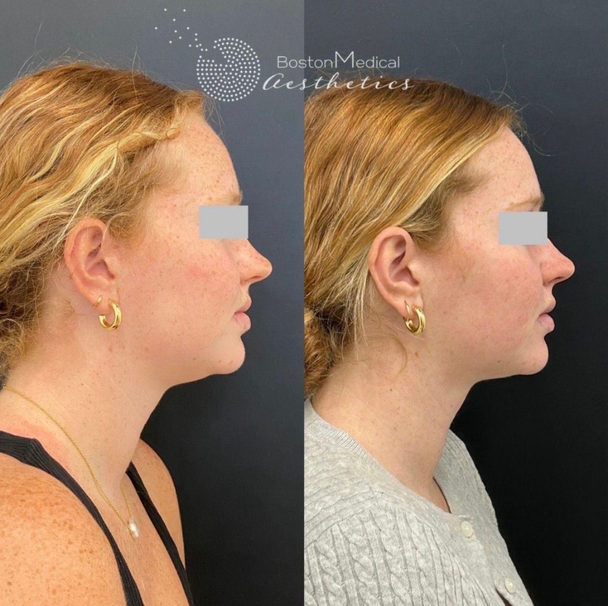 Kybella Before & After Photo