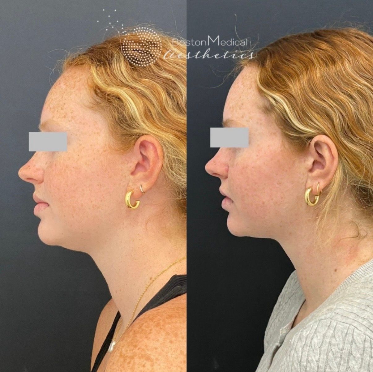 Kybella Before & After Photo