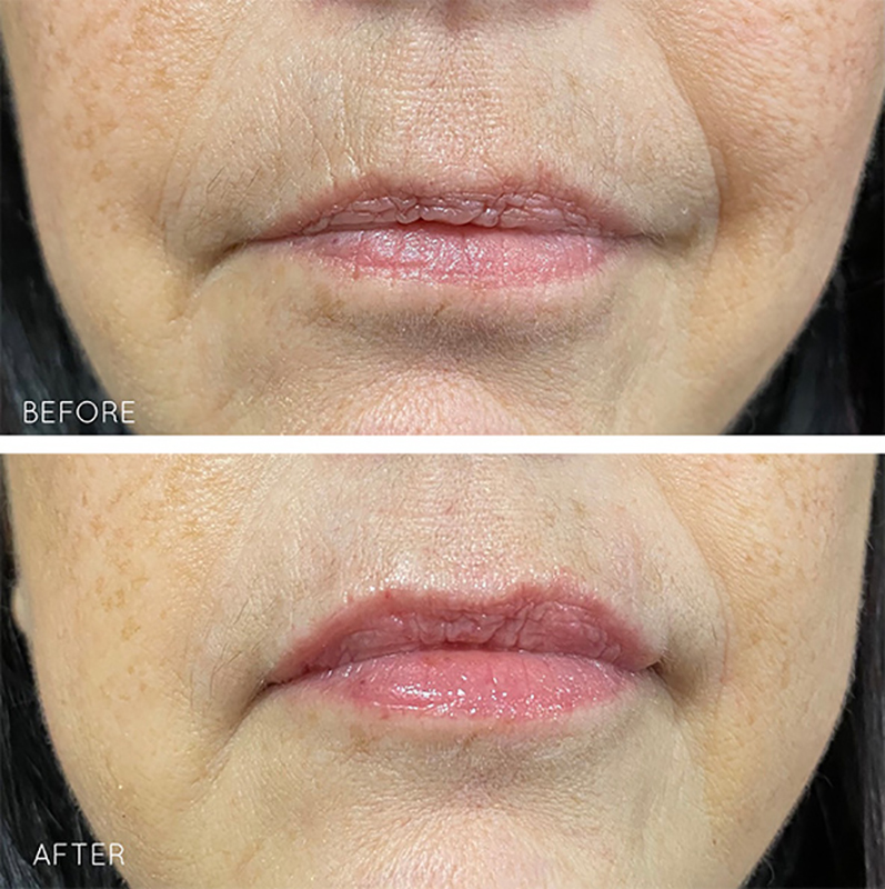 Lip Fillers Before & After Photo