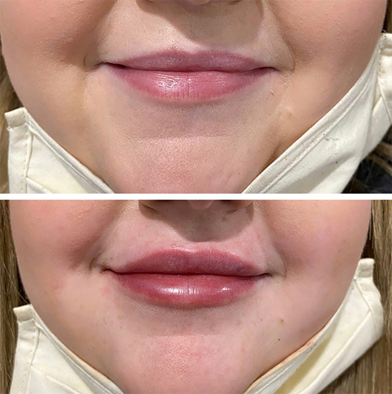 Lip Fillers Before & After Photo