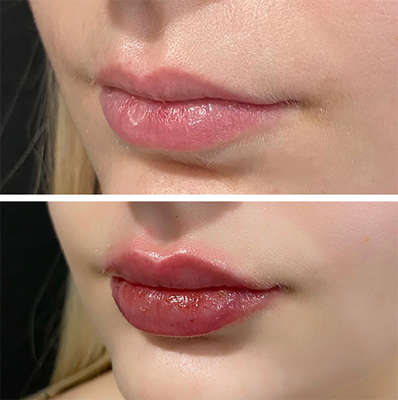 Lip Fillers Before & After Photo