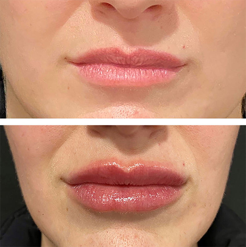 Lip Fillers Before & After Photo