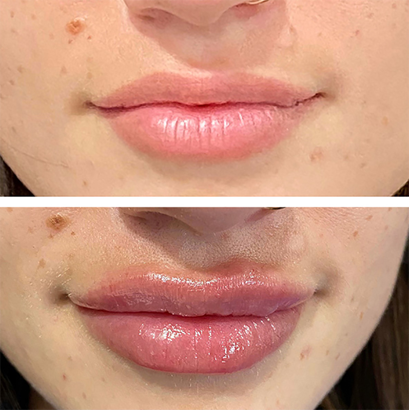Lip fillers Before & After Image