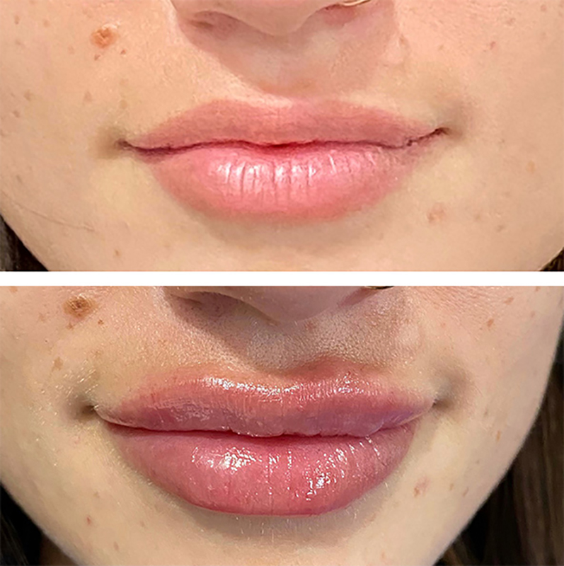 Lip Fillers Before & After Photo