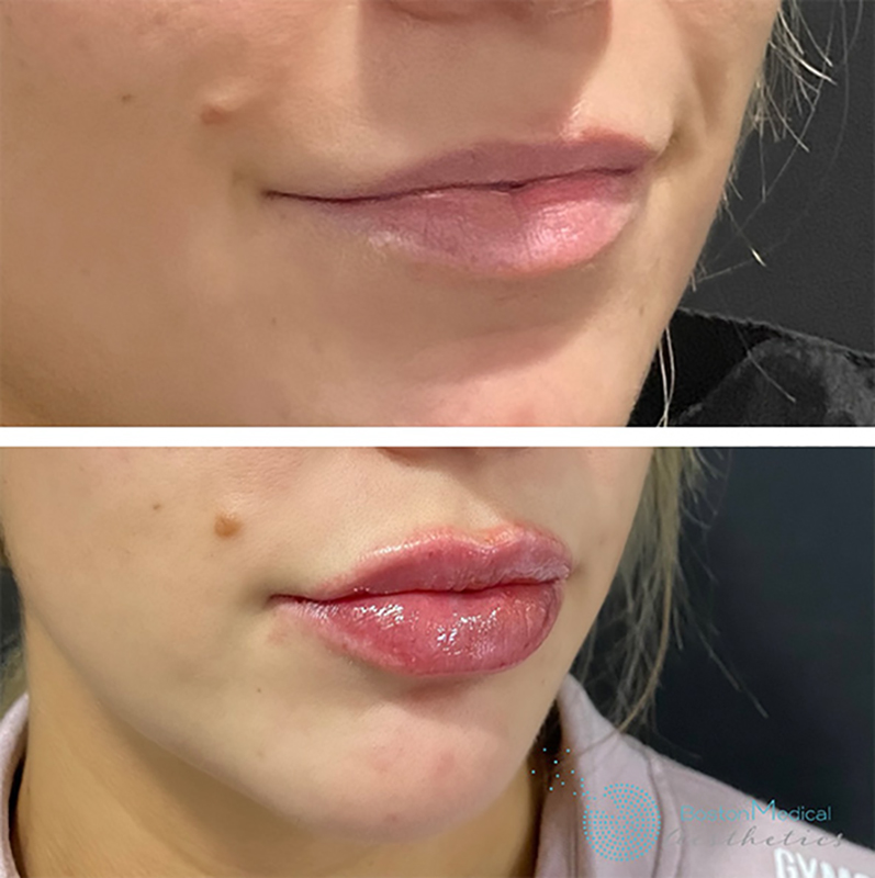 Lip fillers Before & After Image