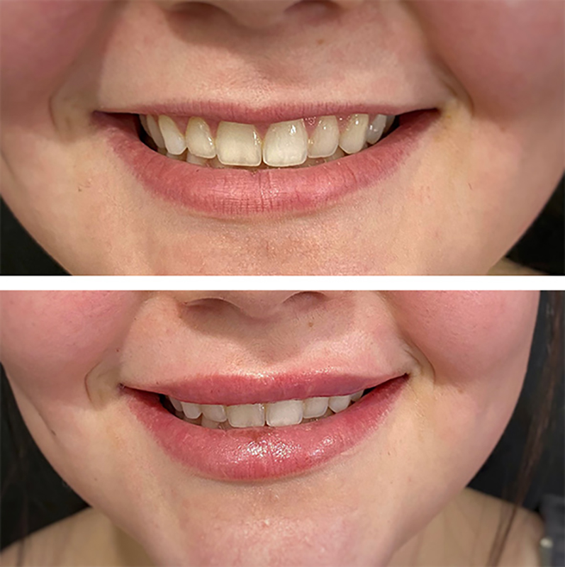 Lip fillers Before & After Image