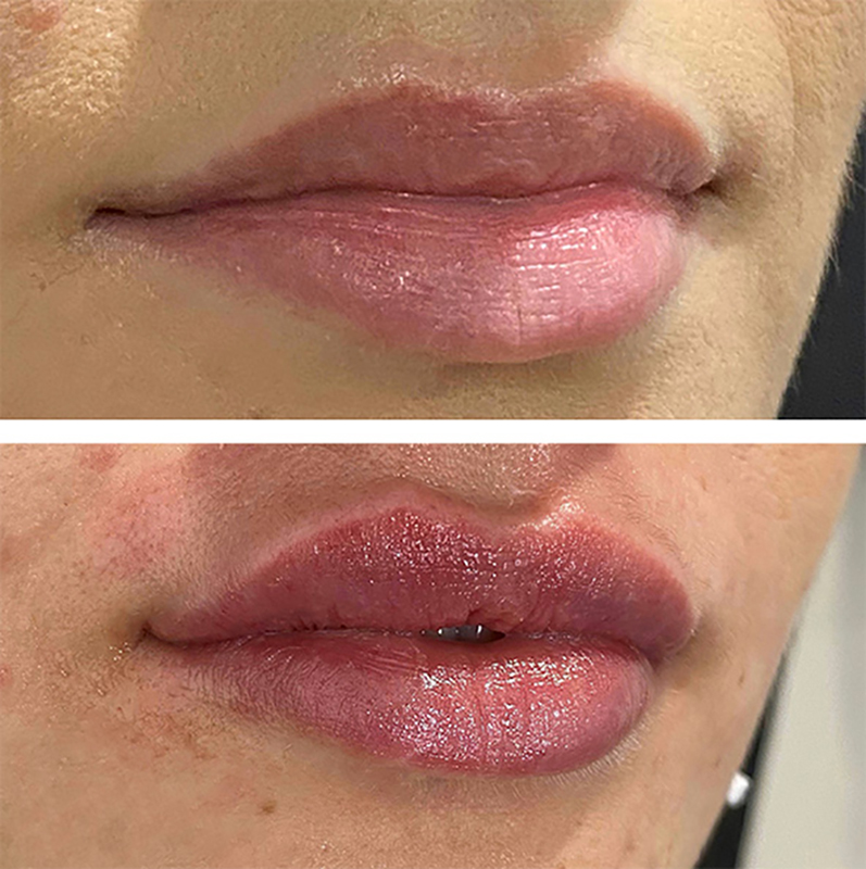 Lip fillers Before & After Image