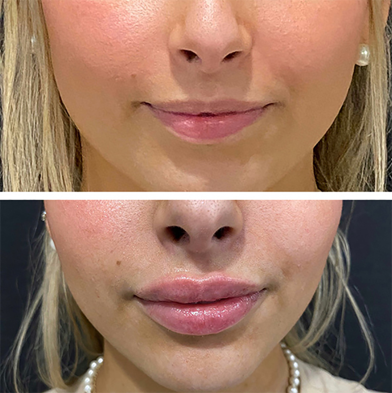 Lip fillers Before & After Image