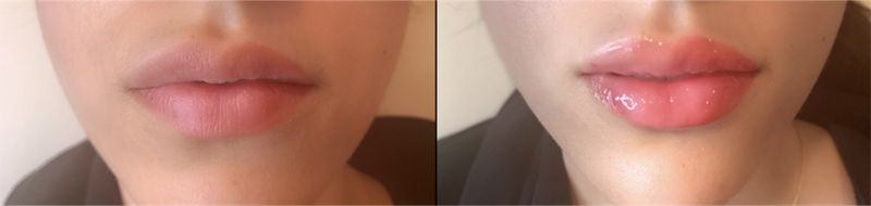 Lip fillers Before & After Image