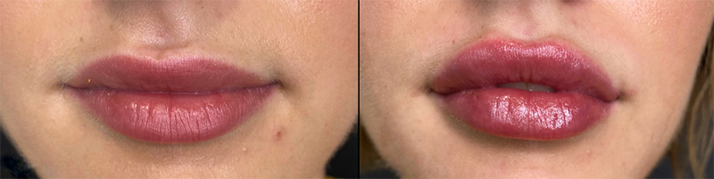 Lip fillers Before & After Image