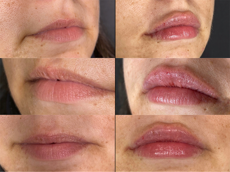 Lip Fillers Before & After Photo