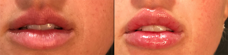 Lip fillers Before & After Image