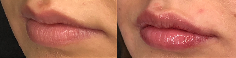 Lip fillers Before & After Image