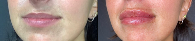 Lip fillers Before & After Image