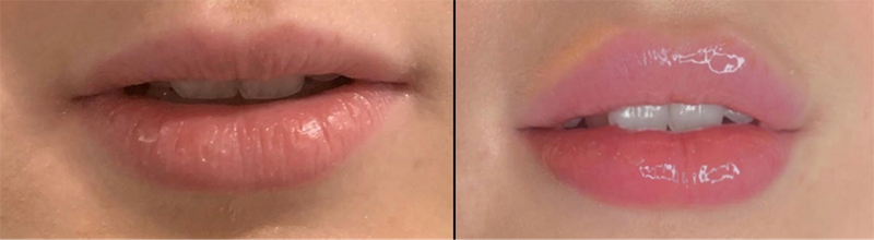Lip fillers Before & After Image