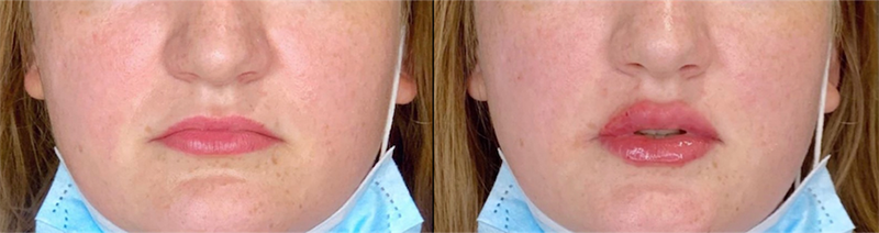 Lip fillers Before & After Image