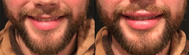 Lip fillers Before & After Image