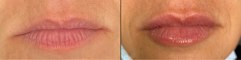 Lip fillers Before & After Image