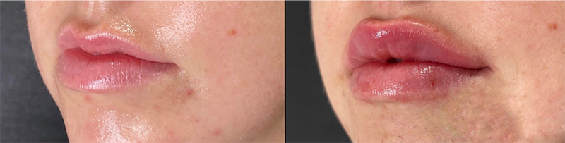 Lip fillers Before & After Image