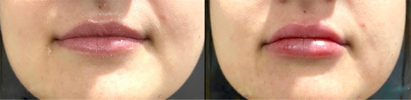 Lip fillers Before & After Image