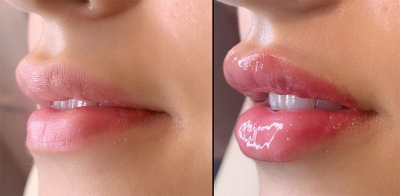 Lip fillers Before & After Image