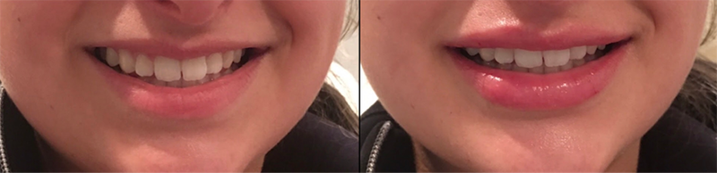 Lip fillers Before & After Image