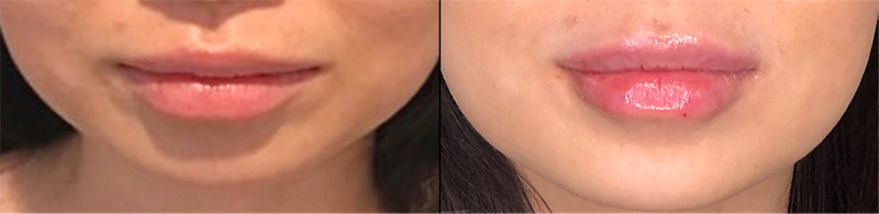 Lip fillers Before & After Image