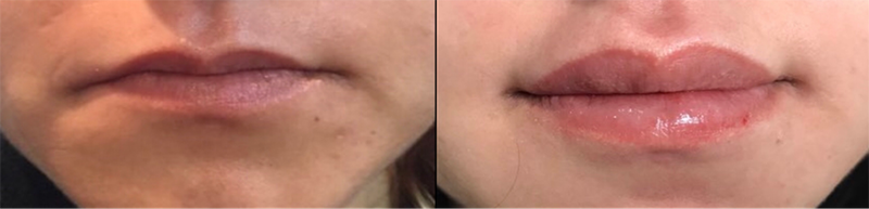 Lip fillers Before & After Image
