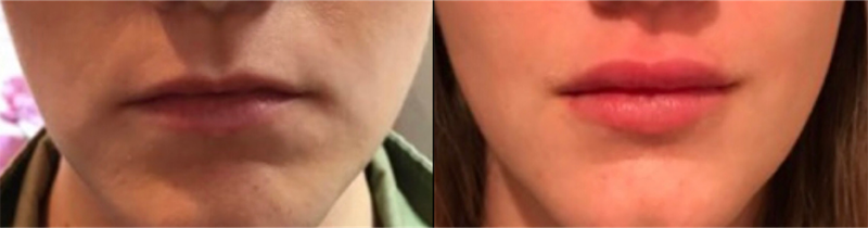 Lip fillers Before & After Image