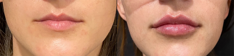 Lip fillers Before & After Image
