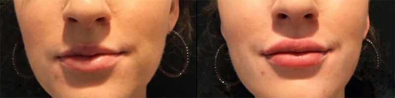 Lip fillers Before & After Image