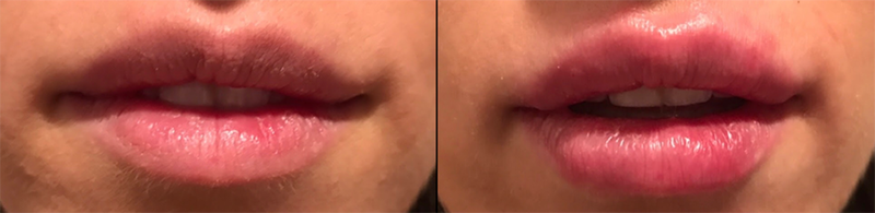 Lip fillers Before & After Image
