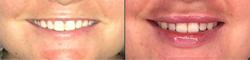 Lip fillers Before & After Image