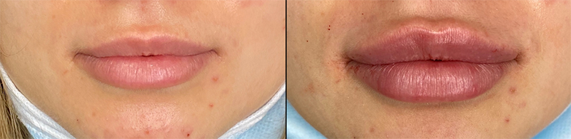 Lip fillers Before & After Image
