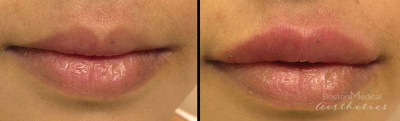 Lip fillers Before & After Image