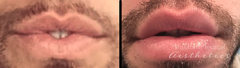 Lip Fillers Before & After Photo