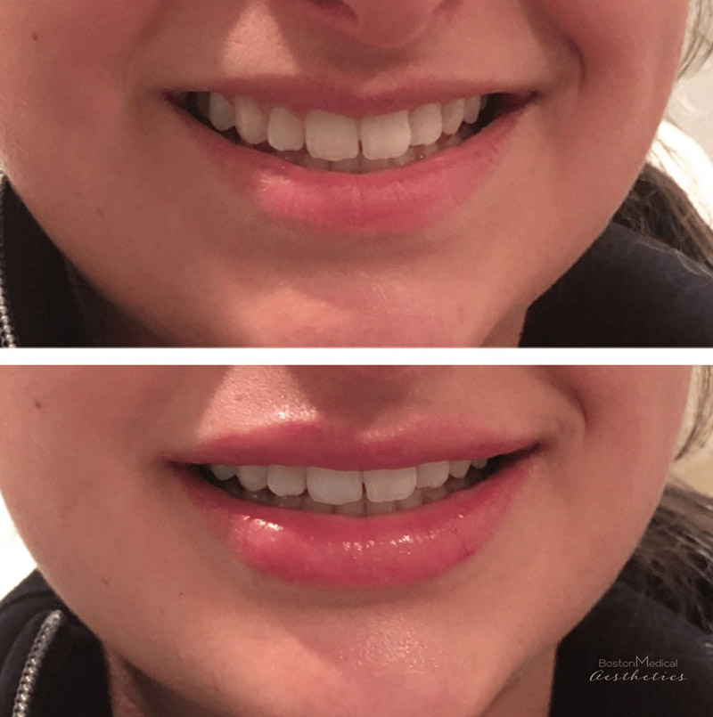 Lip fillers Before & After Image