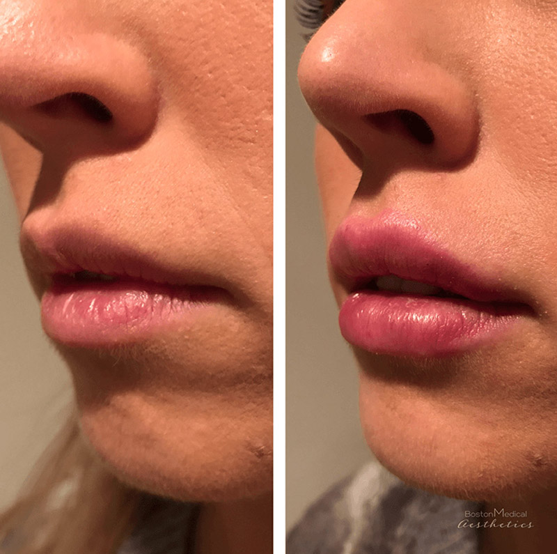 Lip fillers Before & After Image