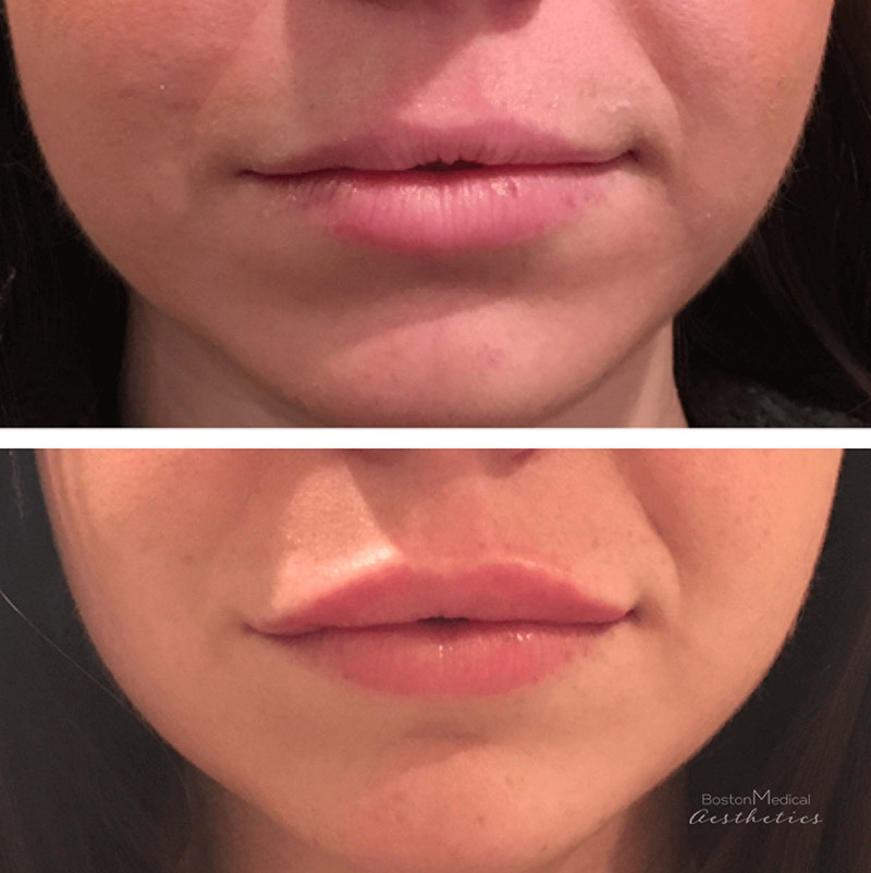 Lip fillers Before & After Image