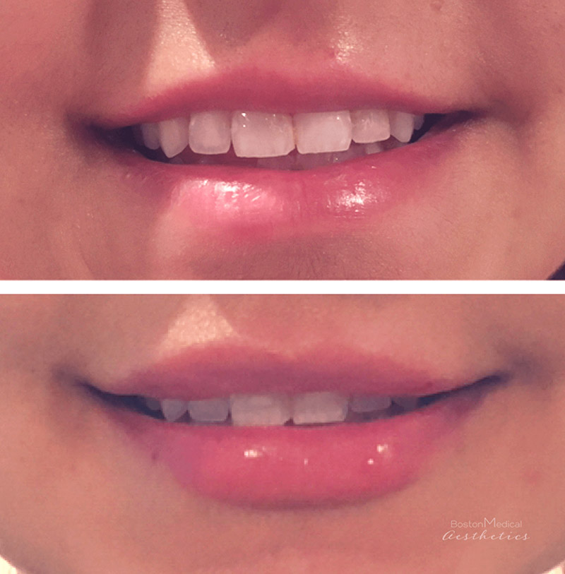 Lip fillers Before & After Image