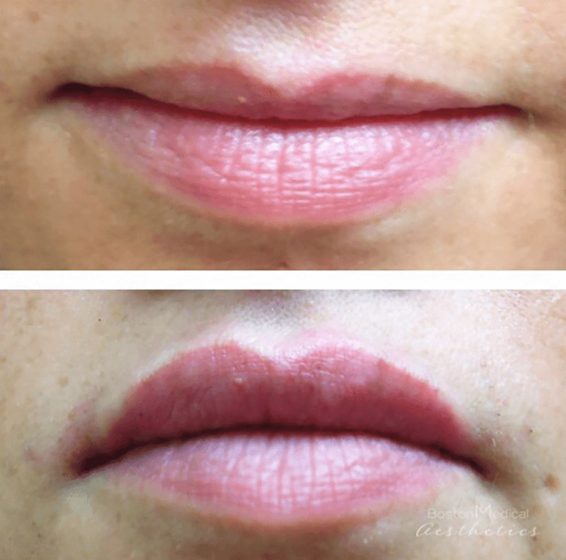 Lip fillers Before & After Image