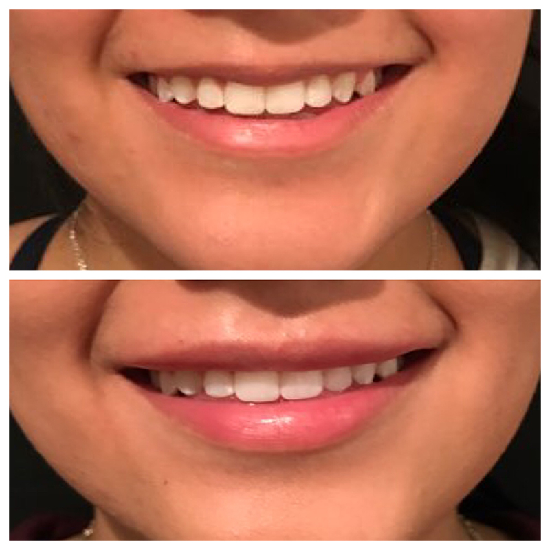 Lip fillers Before & After Image
