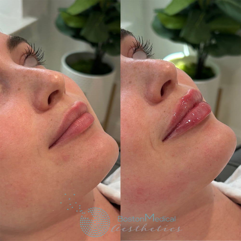 Lip fillers Before & After Image