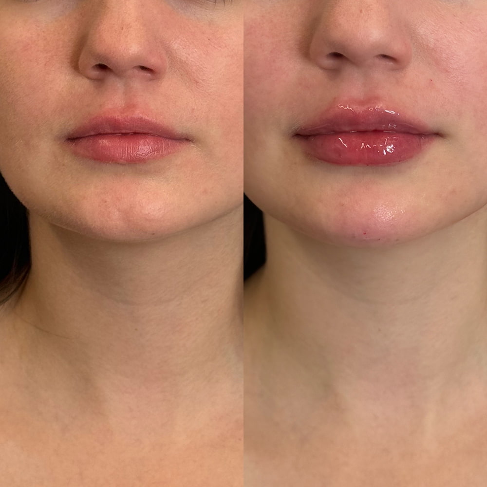 Lip fillers Before & After Image