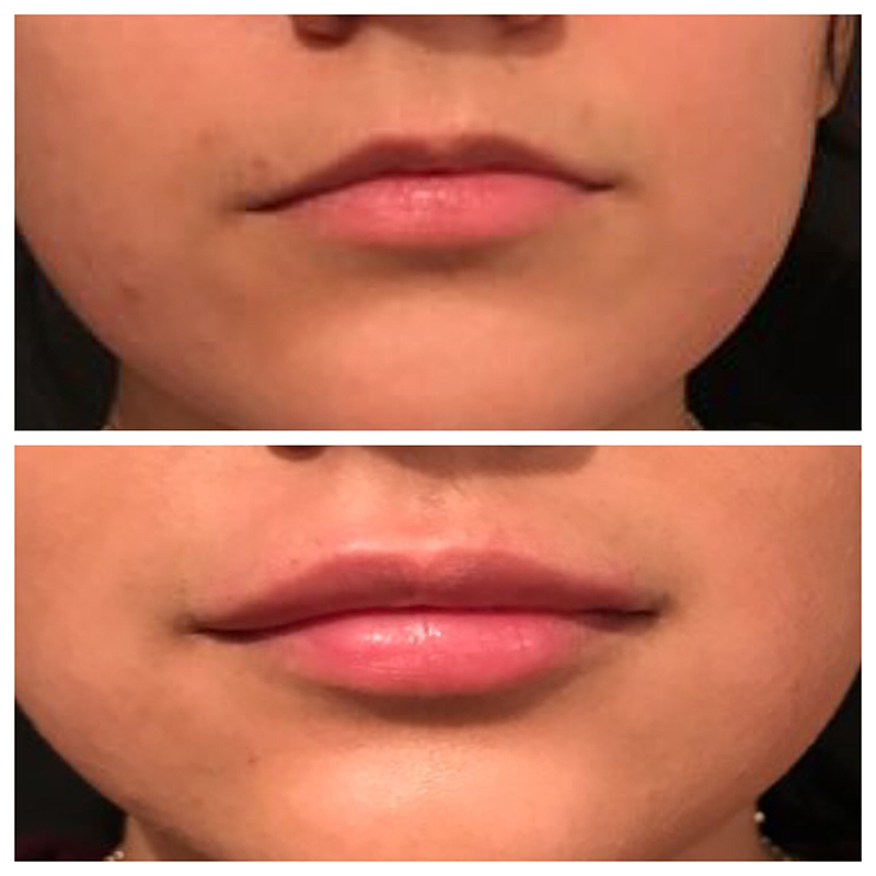 Lip Fillers Before & After Photo