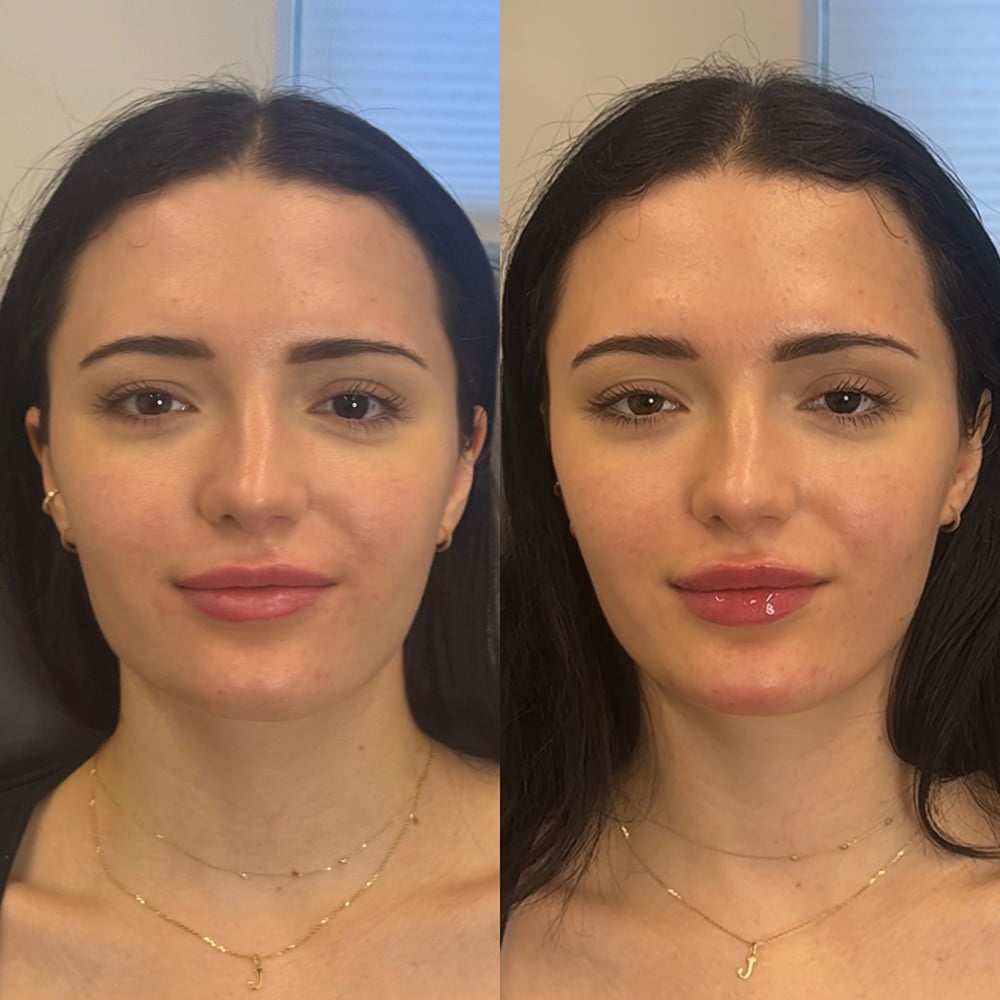 Lip fillers Before & After Image
