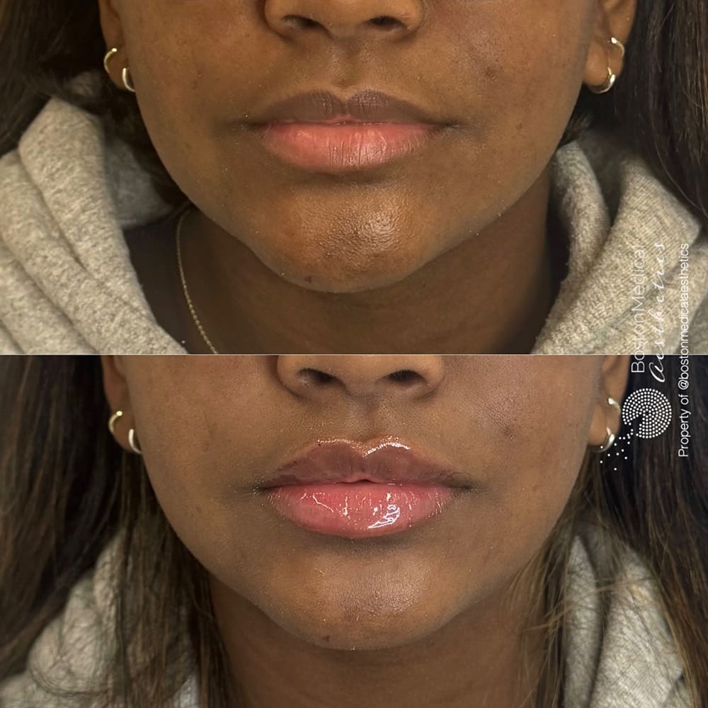 Lip fillers Before & After Image