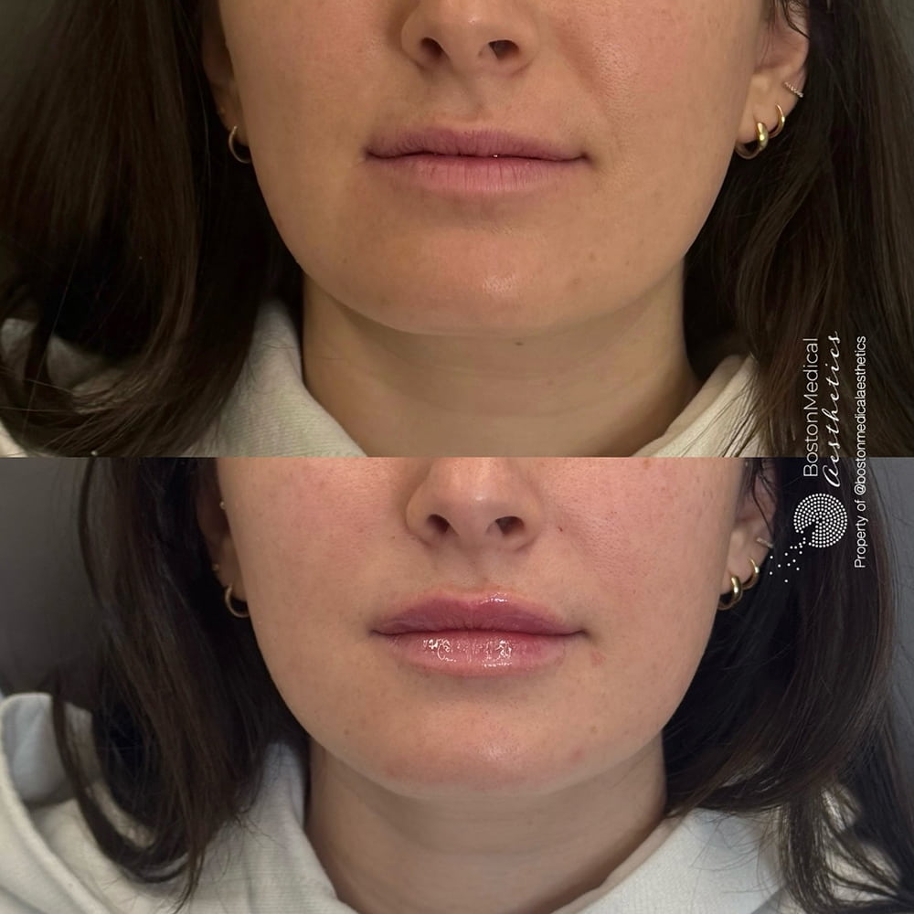Lip fillers Before & After Image
